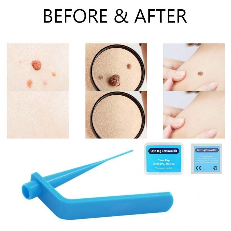 Home Micro Skin Tag Remover Set Medium Body Mole Wart Tag Removal Band